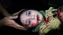 Das UNICEF-Foto des Jahres 2013 zeigt das blutverschmierte Gesicht der elfjährigen Dania aus Aleppo (Syrien), die beim Spielen durch Bombensplitter im Gesicht verletzt wurde.